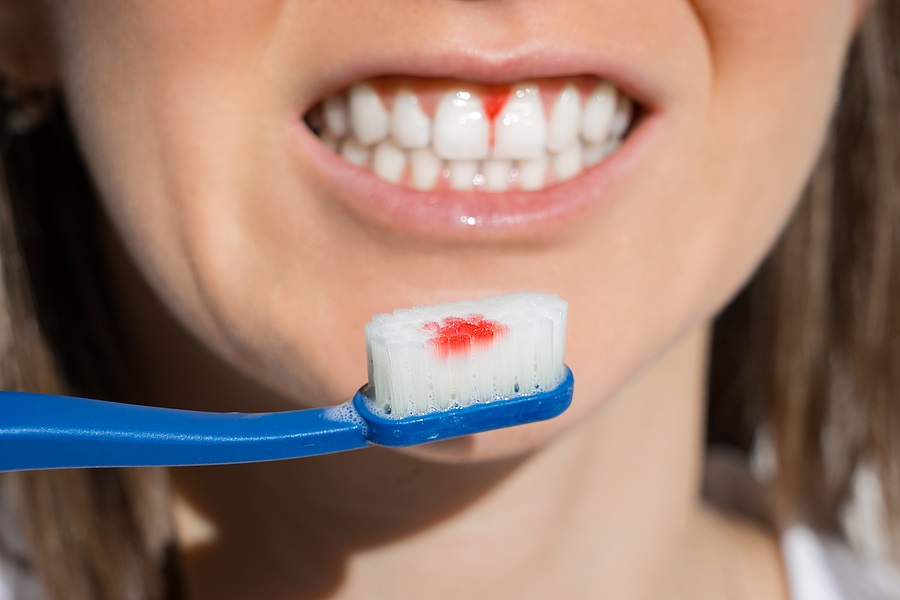 GUM DISEASE – THE DOMINO EFFECT