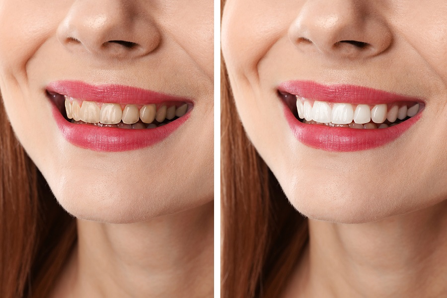 REJUVENATE YOUR SMILE WITH TEETH WHITENING IN ALTAMONTE SPRINGS!