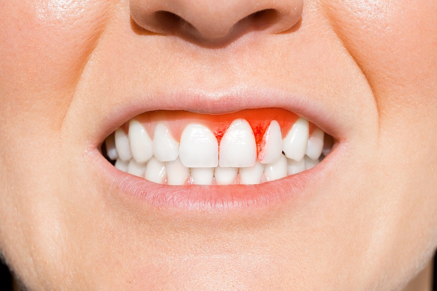 HOW CAN A DENTIST IN ALTAMONTE SPRINGS HELP GUM HEALTH?